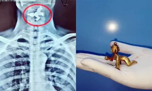 தீர்த்தத்துடன் சேர்த்து, 50 கிராம் கிருஷ்ணர் சிலையை விழுங்கிய வியாபாரி- அறுவை சிகிச்சை செய்து டாக்டர்கள் வெளியே எடுத்தனர்