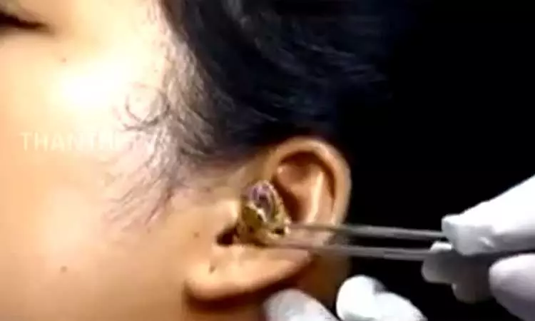 பெண்ணின் காதுக்குள் புகுந்த பாம்பு - ​நெஞ்சை பதைபதைக்கும் வீடியோ