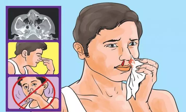 குழந்தைகளுக்கு மூக்கில் இருந்து ரத்தம் வர காரணங்கள் குழந்தைகளுக்கு மூக்கில் இருந்து ரத்தம் வர காரணங்கள்