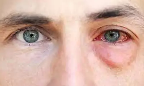 வேகமாக பரவி வரும் கண்நோய்