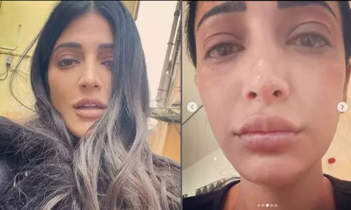 மோசமான ஹேர்...! வீங்கிய முகம்....! இன்ன பிற… ! புகைப்படங்களை வெளியிட்ட சுருதிஹாசன்