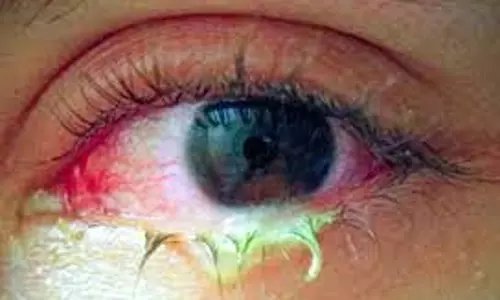 பருவமழை தொடக்கம்:  கண்களில் இமைப்படல அழற்சி நோயில் இருந்து தற்காத்து கொள்ள வேண்டும்  கலெக்டர் ஸ்ரேயா சிங் அறிவுறுத்தல்