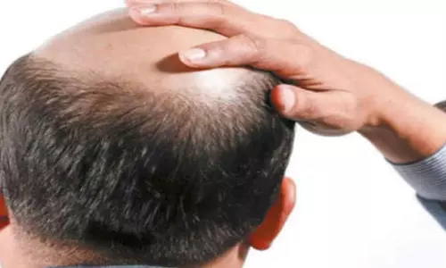 வழுக்கை தலை உடையவர்களுக்கு மாதம் ரூ.6 ஆயிரம் ஓய்வூதியம் வேண்டும் புதிதாக சங்கம் அமைத்து கோரிக்கை வழுக்கை தலை உடையவர்களுக்கு மாதம் ரூ.6 ஆயிரம் ஓய்வூதியம் வேண்டும் புதிதாக சங்கம் அமைத்து கோரிக்கை