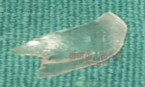 7 மாத குழந்தையின் தொண்டையில் சிக்கிய பிளாஸ்டிக் துண்டு அகற்றம்