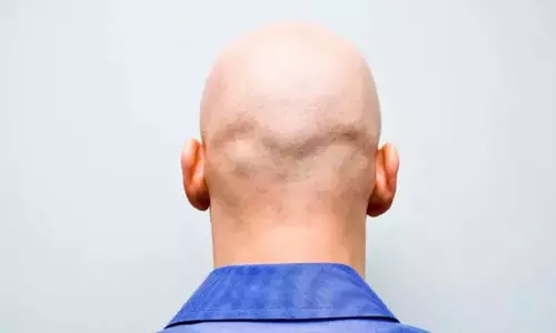 வழுக்கையால் வந்த அதிர்ஷ்டம்: வேலையை இழந்த நபருக்கு ரூ.70 லட்சம் நஷ்டஈடு வழங்க கோர்ட்டு உத்தரவு வழுக்கையால் வந்த அதிர்ஷ்டம்: வேலையை இழந்த நபருக்கு ரூ.70 லட்சம் நஷ்டஈடு வழங்க கோர்ட்டு உத்தரவு