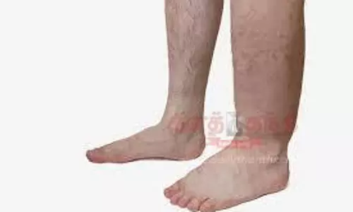 யானைக்கால் நோய் பாதிக்கப்பட்டவர்களுக்கு உபகரணங்கள்