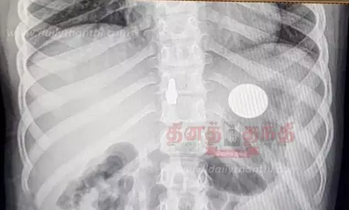 5 ரூபாய் நாணயத்தை விழுங்கிய சிறுமி