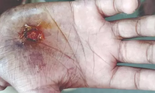 சிறுவர்கள் கடினமான வேலைகளில் ஈடுபடுவதால் கைகள் புண்ணாகும் நிலை