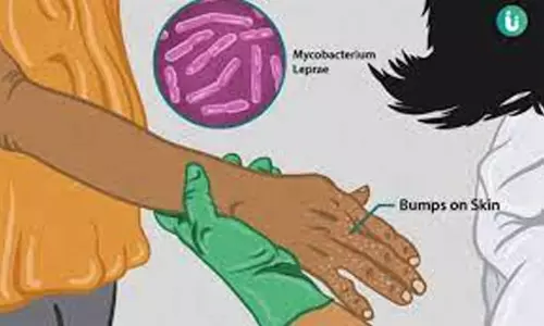 தொழுநோய் கண்டறியும் பணி தீவிரம்