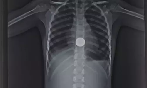 குழந்தையின் உணவுக்குழாயில் சிக்கிய 5 ரூபாய் நாணயம் அகற்றம்