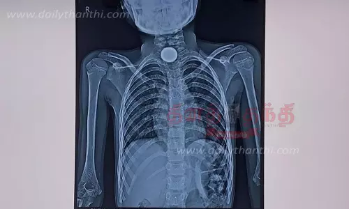 5 ரூபாய் நாணயத்தை விழுங்கிய 9 வயது சிறுமி-தொண்டையில் சிக்கி இருந்ததை அரசு டாக்டர்கள் லாவகமாக எடுத்தனர்