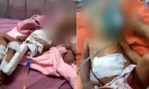 கை அகற்றப்பட்ட குழந்தை உயிரிழப்பு - அரசு மருத்துவமனை விளக்கம்