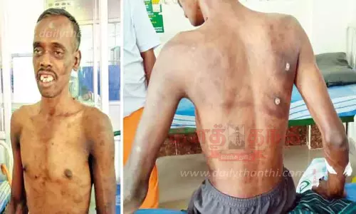 மனநலம் பாதிக்கப்பட்ட வாலிபர் உடலில் தீக்காயங்களுடன் ஆஸ்பத்திரியில் அனுமதி