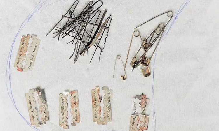 மனநலம் பாதித்த இளைஞர் வயிற்றில் இருந்த ஹேர்பின், பிளேடு, ஊக்குகள் - எண்டோஸ்கோபிக் கருவி மூலம் அகற்றிய மருத்துவர்கள்