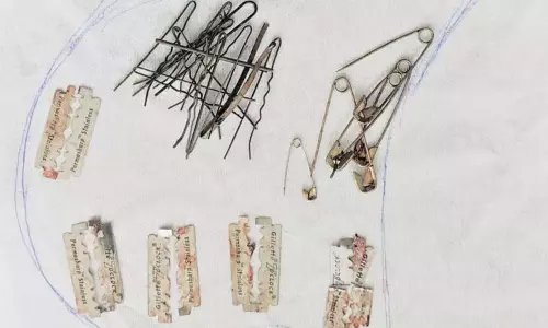 மனநலம் பாதித்த இளைஞர் வயிற்றில் இருந்த ஹேர்பின், பிளேடு, ஊக்குகள் - எண்டோஸ்கோபிக் கருவி மூலம் அகற்றிய மருத்துவர்கள்