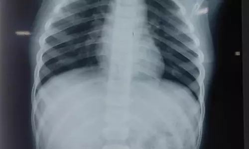 சிறுவனின் உணவு குழாயில் சிக்கியிருந்த நாணயங்கள் அறுவை சிகிச்சையின்றி அகற்றம்