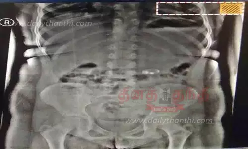 காரைக்குடியில் சிறுமி விழுங்கிய தங்க மோதிரத்தை அறுவை சிகிச்சையின்றி வெளியே எடுத்த டாக்டர்கள்