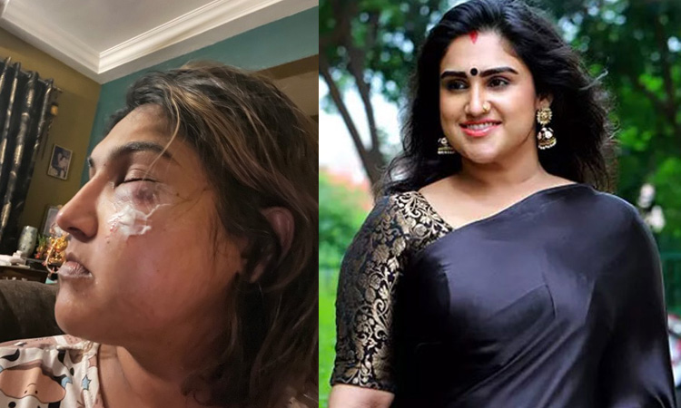 மர்மநபர் தாக்கியதாக குற்றச்சாட்டு - காயத்துடன் புகைப்படம் வெளியிட்ட வனிதா விஜயகுமார்