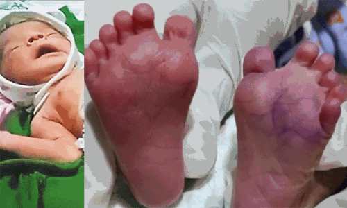 25 விரல்களுடன் பிறந்த அதிசய குழந்தை: ஆச்சரியத்தில் குடும்பத்தினர்