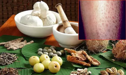 சொரியாசிஸ் என்னும் செதில் உதிர் நோய் சொரியாசிஸ் என்னும் செதில் உதிர் நோய்