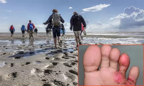 சேற்றுப் புண்ணை எளிதில் குணப்படுத்தும் சித்த மருத்துவம்