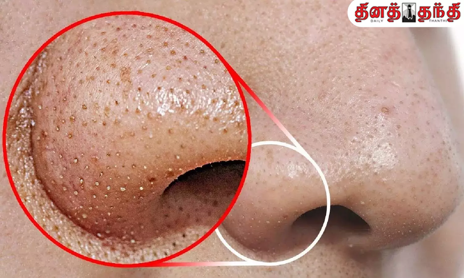 மூக்கை சுற்றியுள்ள கருமை மற்றும் வெள்ளை புள்ளிகளை தவிர்ப்பதற்கான வீட்டு குறிப்புகள்..!