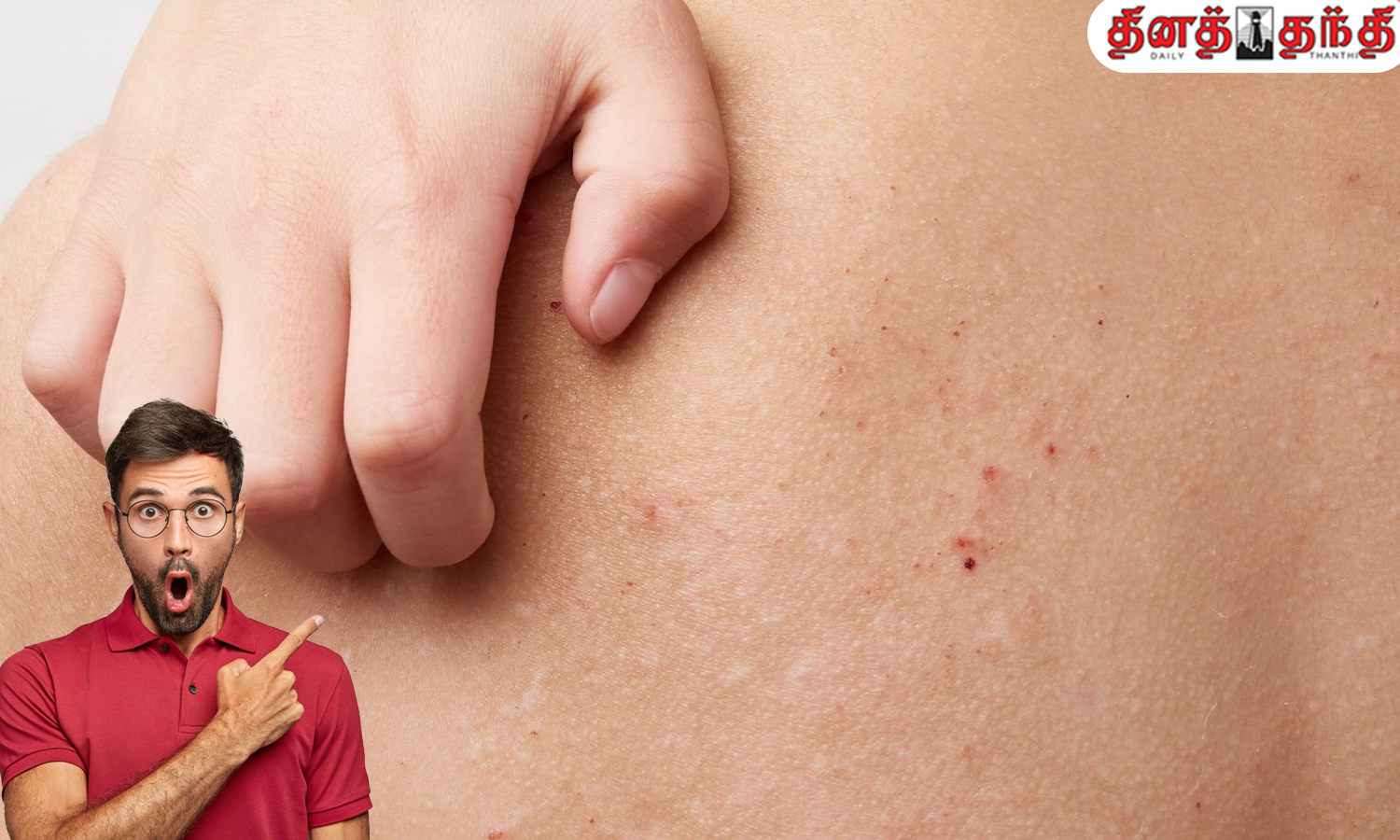 வெயில் காலத்தில் பாடாய்ப்படுத்தும் வியர்க்குருவை தடுப்பதற்கான வழிமுறைகள்..!