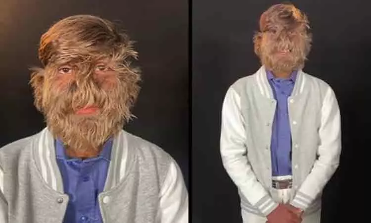 முகத்தில் அதிக முடிகள்..!  கின்னஸ் சாதனை படைத்த இந்திய இளைஞர்