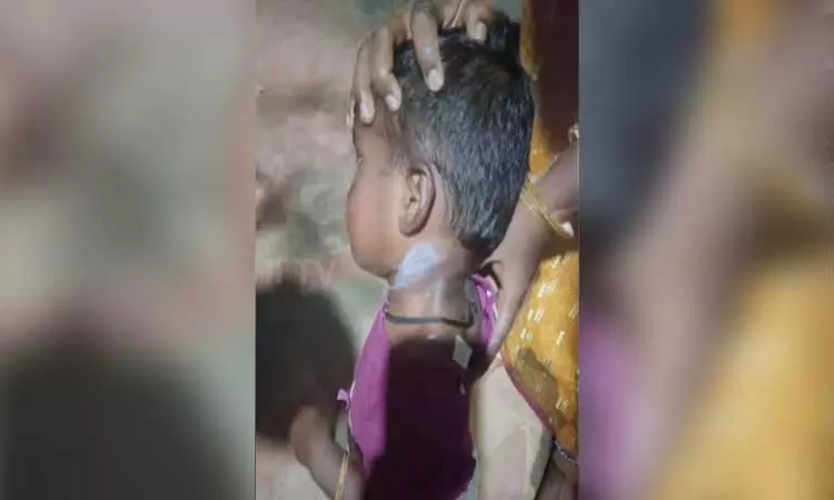 இரண்டரை வயது குழந்தைக்கு சூடுவைத்த அங்கன்வாடி ஊழியர் - திண்டுக்கல்லில் அதிர்ச்சி சம்பவம்