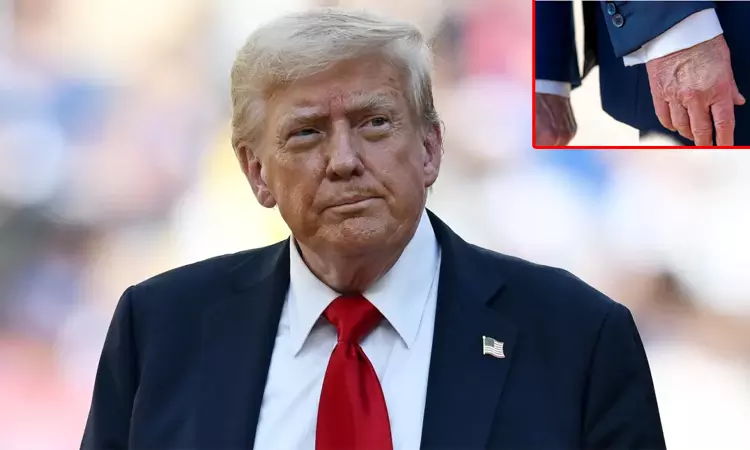 அமெரிக்க ஜனாதிபதி டிரம்ப்பிற்கு நரம்பு நோய் பாதிப்பு