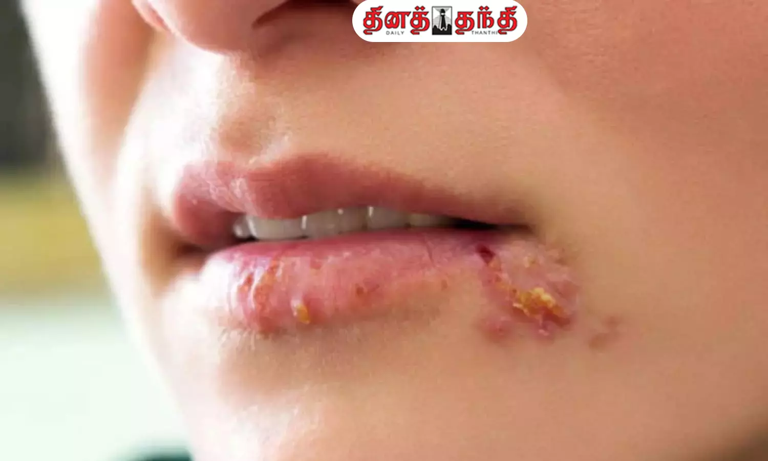 எதனால் அடிக்கடி வாய்ப்புண் ஏற்படுகிறது தெரியுமா?