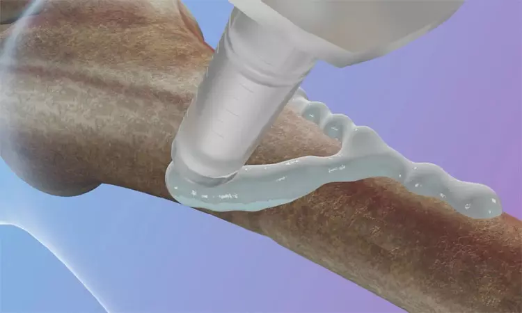 எலும்புகளை ஒட்ட வைக்கும் பசை எலும்புகளை ஒட்ட வைக்கும் பசை