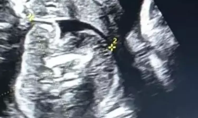 பிறந்த குழந்தையின் வயிற்றில் கரு... பெங்களூருவில் விநோதம்