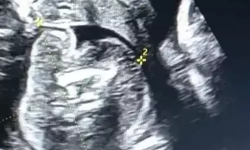 பிறந்த குழந்தையின் வயிற்றில் கரு... பெங்களூருவில் விநோதம்