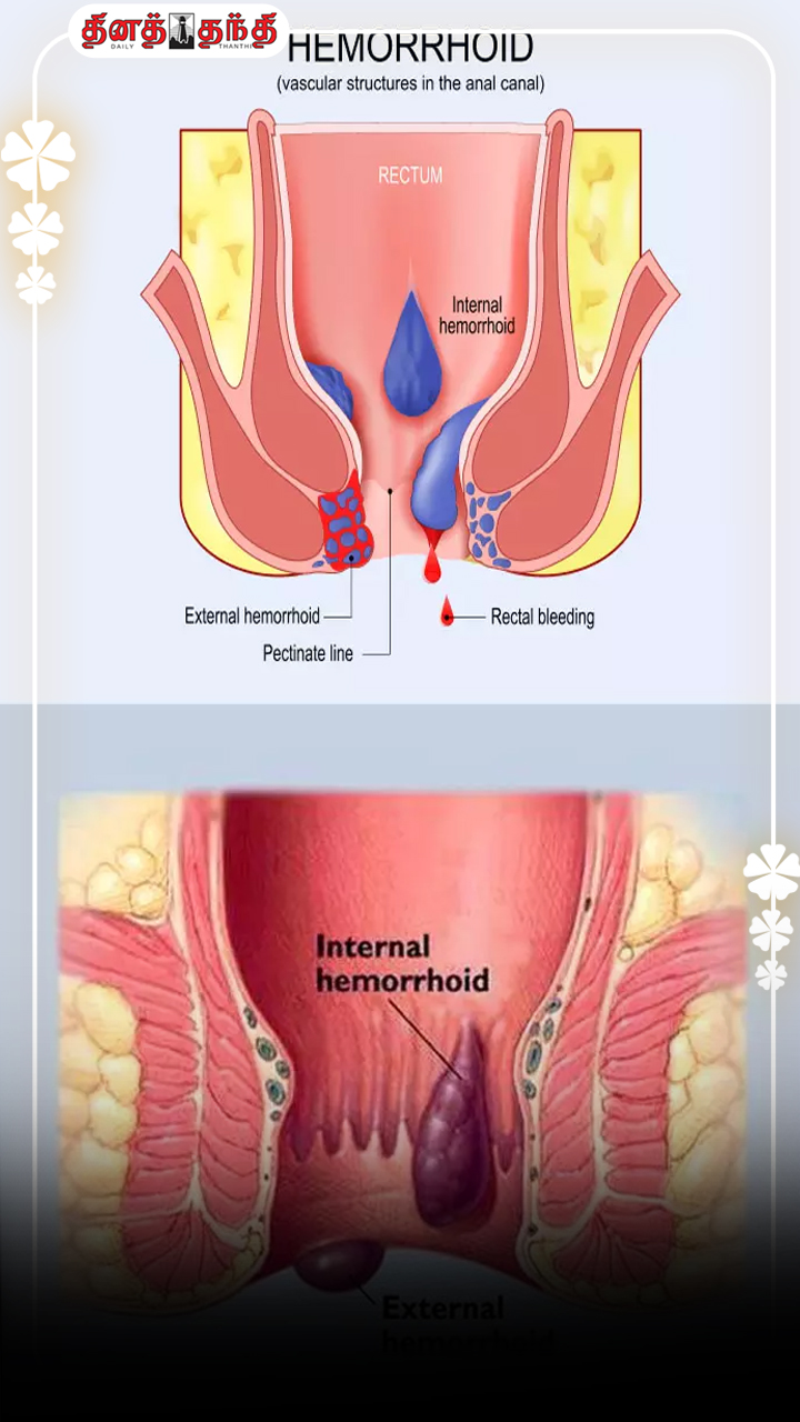 உணவு முறை: அதிக நேரம் அமர்ந்து வேலை பார்ப்பவரா.. பைல்ஸுக்கான வாய்ப்பு அதிகம்.!!