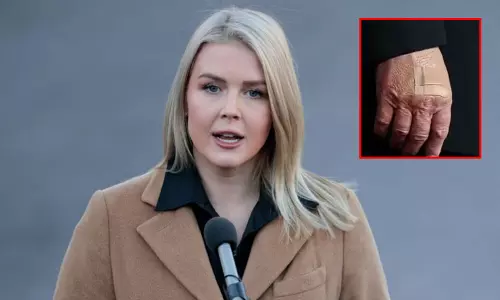 டிரம்பின் வலது கையில் என்ன காயம்...? கரோலின் லீவிட் பரபரப்பு விளக்கம்