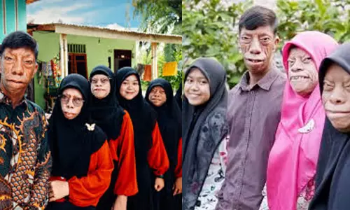 இந்தோனேசியா:  அரிய நோயால் குடும்பமே பாதிப்பு; சமூக ஊடகம் வாயிலாக பிரபலம்