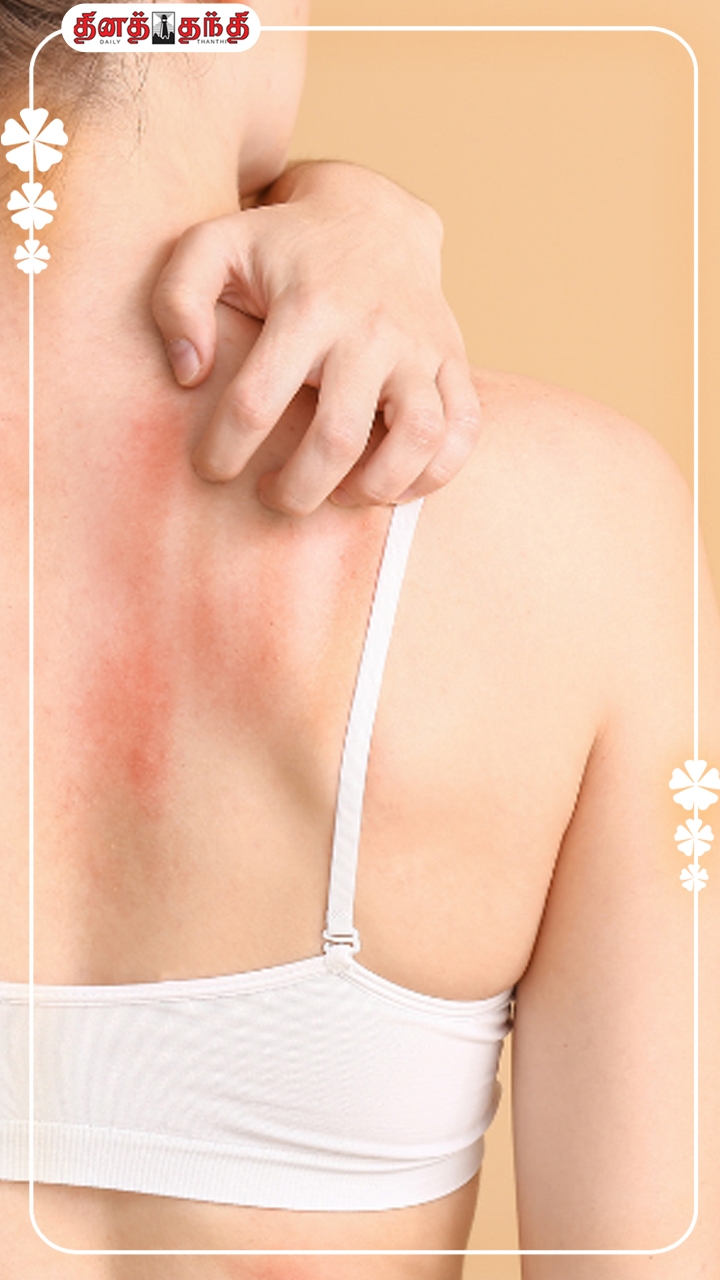 வியர்க்குரு பிரச்சினையா? கவலைய விடுங்க.!!